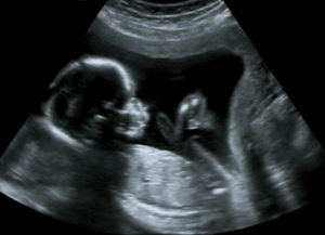 ultrasound_baby